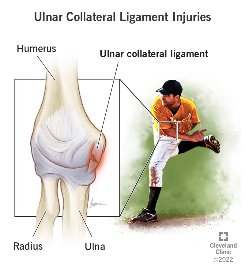 Ulnar Collateral Ligament (UCL) Injuries: Types & Symptoms / Ulnar ...